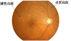 病期分類：単純網膜症 イメージ