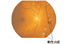 病期分類：増殖前網膜症 イメージ