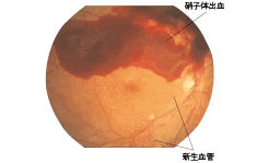 病期分類：増殖網膜症 イメージ