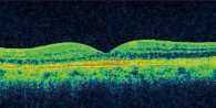 健常な網膜の断層写真