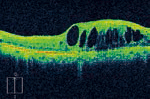 黄斑浮腫の網膜の断層写真
